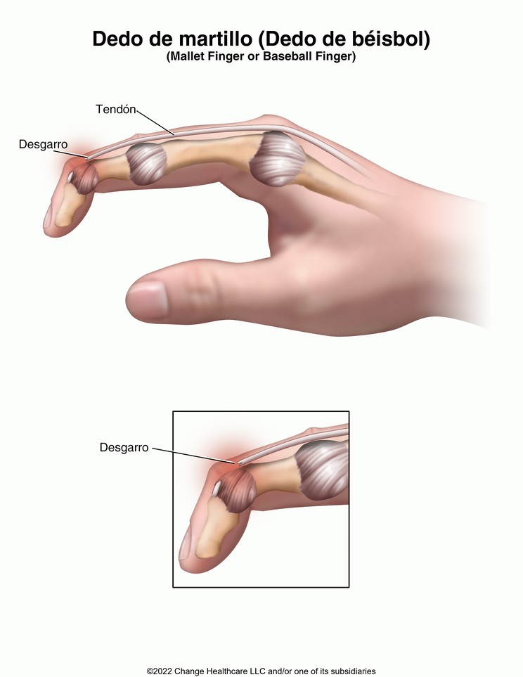 Mallet Finger (Baseball Finger): Illustration