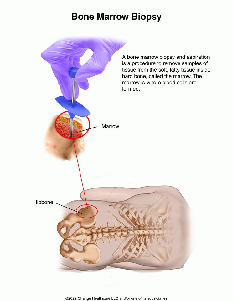 Bone Marrow Biopsy and Aspiration: Illustration