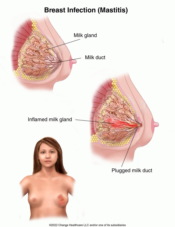 Breast Infection (Mastitis): Illustration