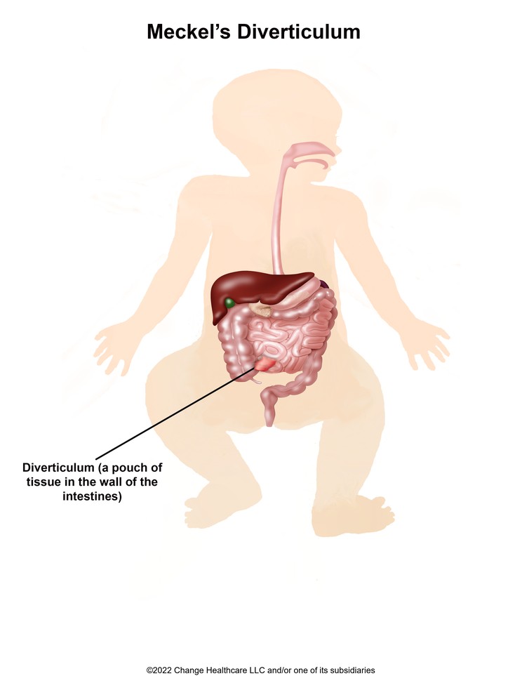 Meckel's Diverticulum: Illustration