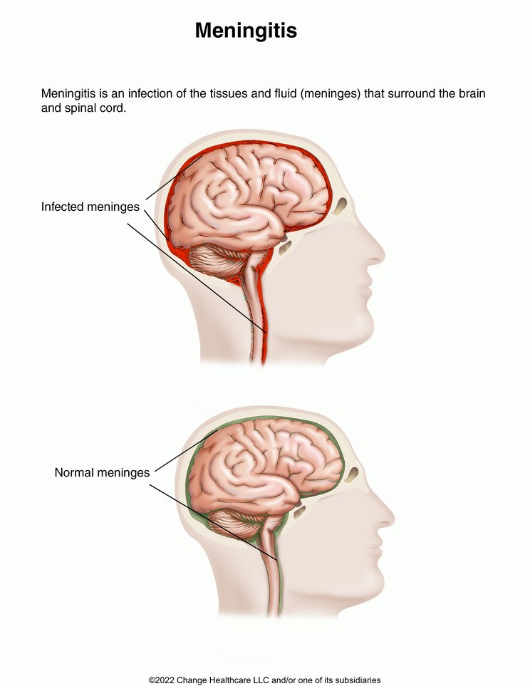 Meningitis: Illustration