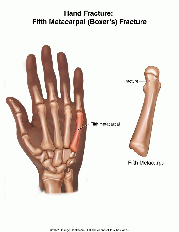 Hand Fracture: Fifth Metacarpal (Boxer's) Fracture: Illustration