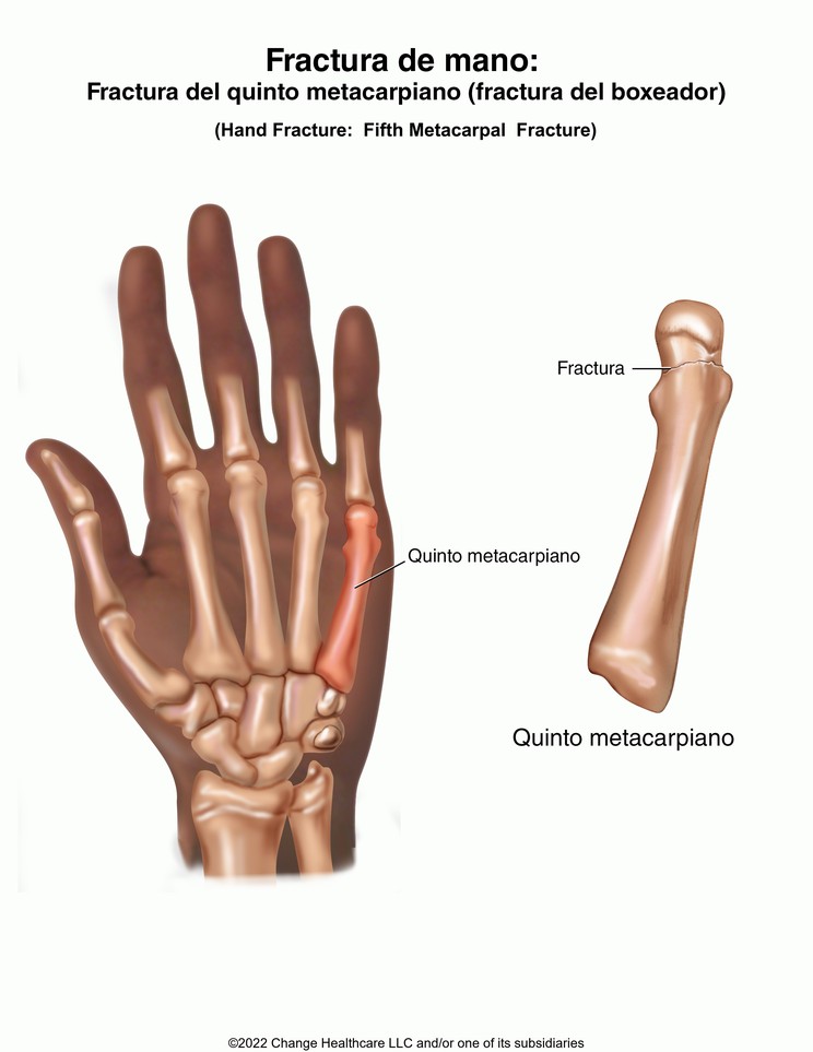 Hand Fracture: Fifth Metacarpal (Boxer's) Fracture: Illustration