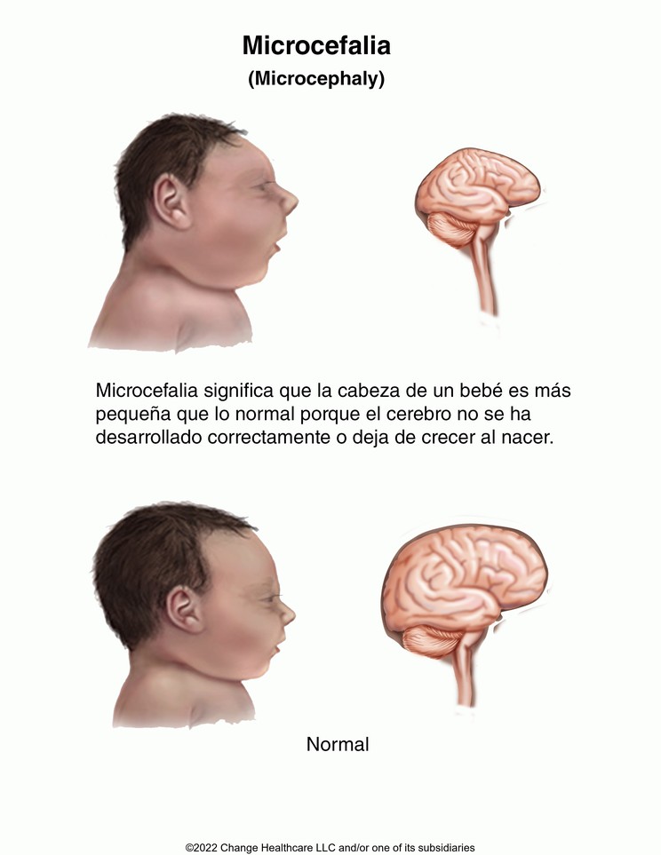 Microcephaly: Illustration