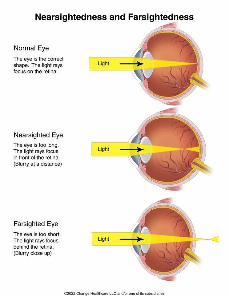 Nearsightedness and Farsightedness: Illustration