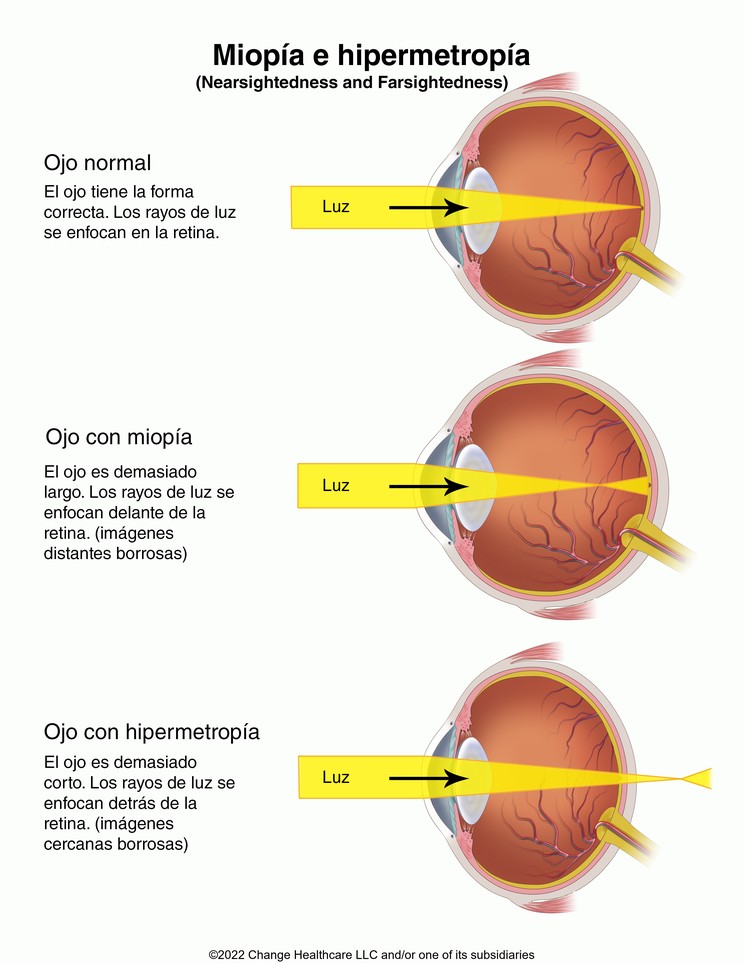Nearsightedness and Farsightedness: Illustration