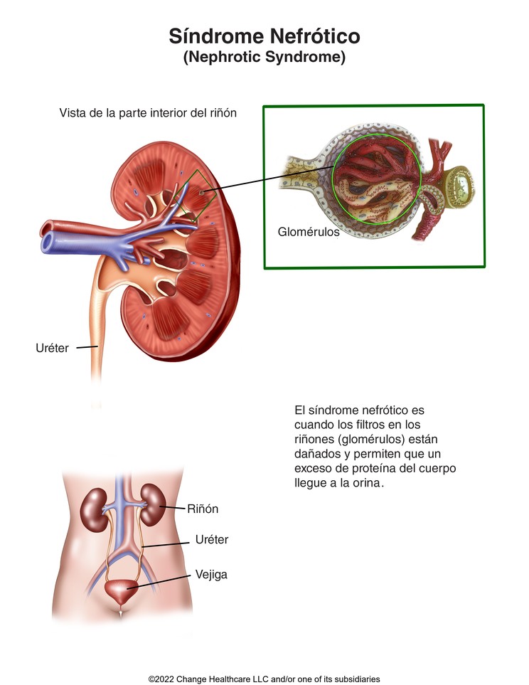 Nephrotic Syndrome: Illustration