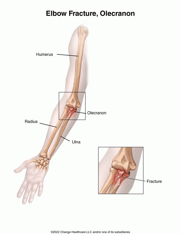 Elbow Fracture: Olecranon Fracture: Illustration