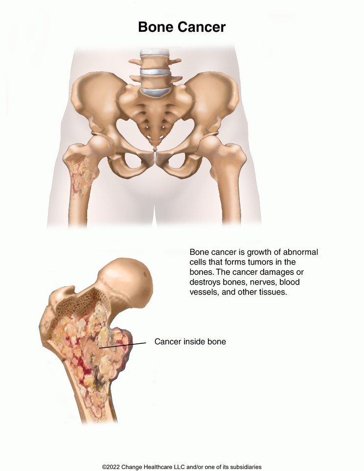 Bone Cancer: Illustration