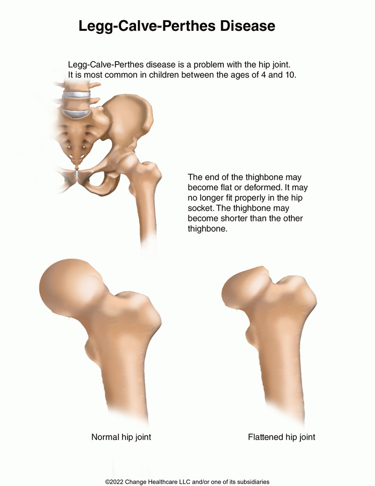 Legg-Calve-Perthes Disease: Illustration