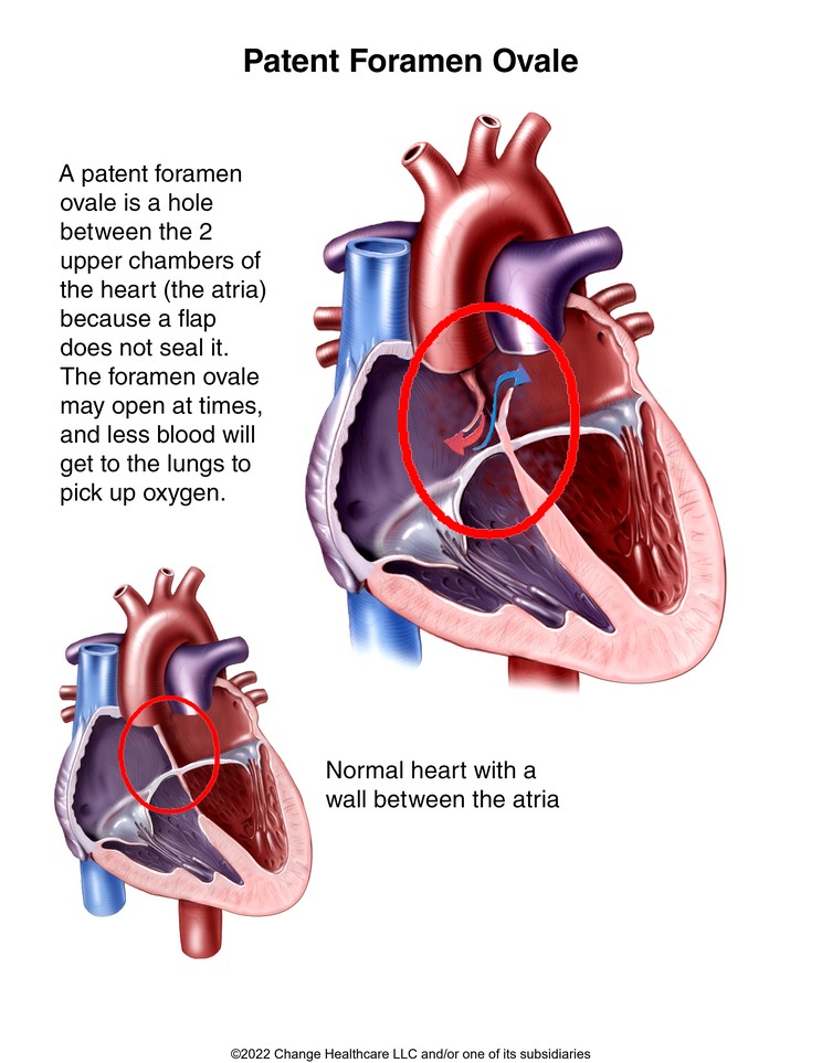 Patent Foramen Ovale: Illustration