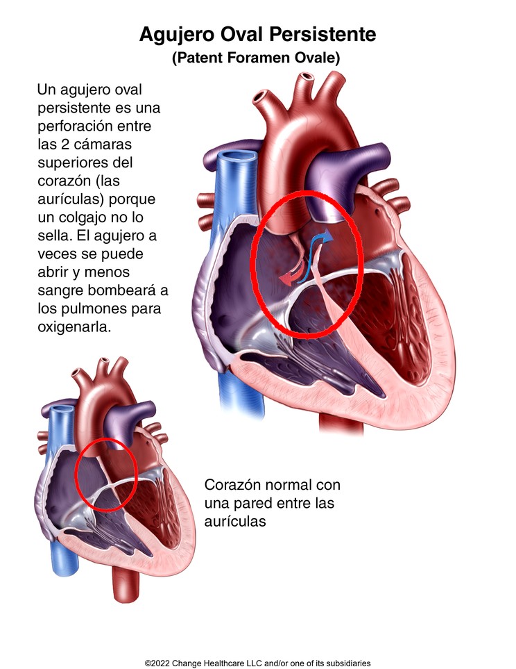 Patent Foramen Ovale: Illustration