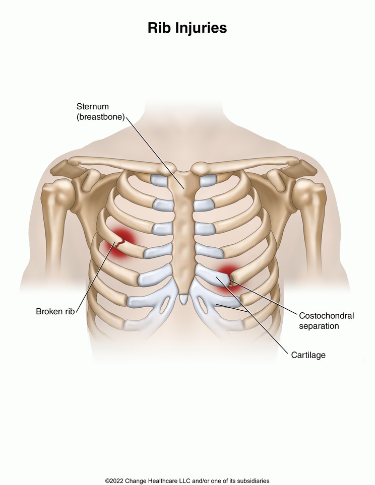 Rib Injuries: Illustration