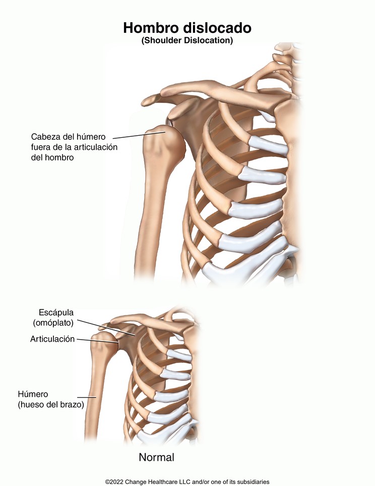 Shoulder Dislocation: Illustration