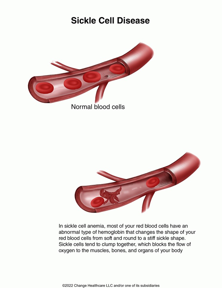 Sickle Cell Anemia: Illustration