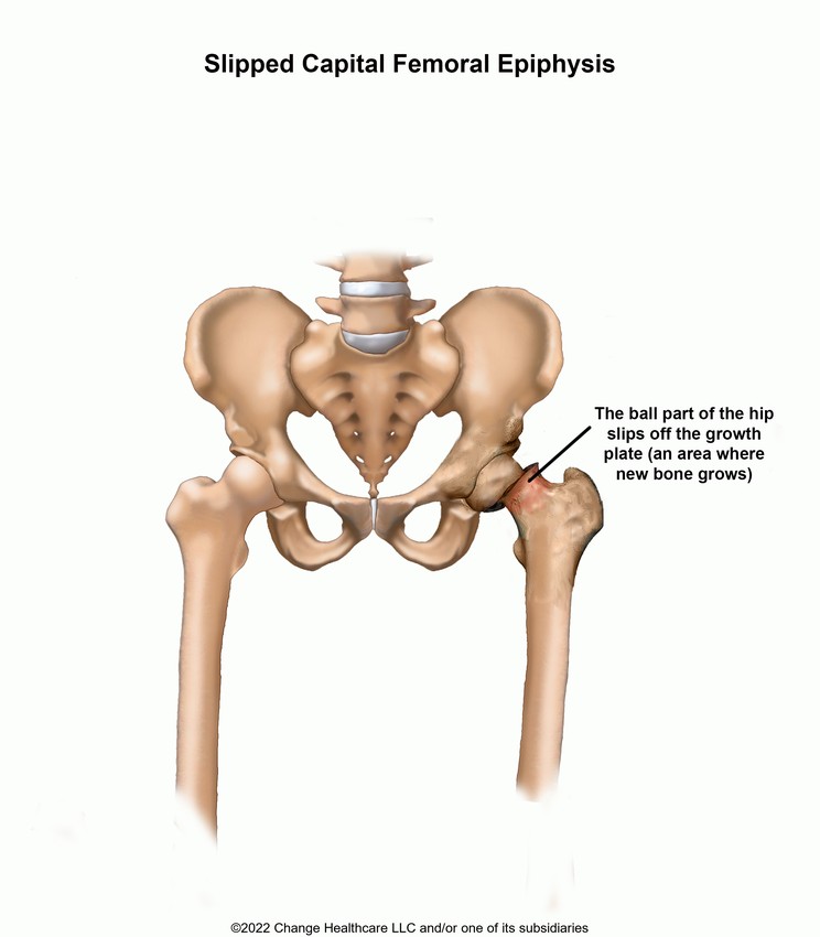 Slipped Capital Femoral Epiphysis: Illustration