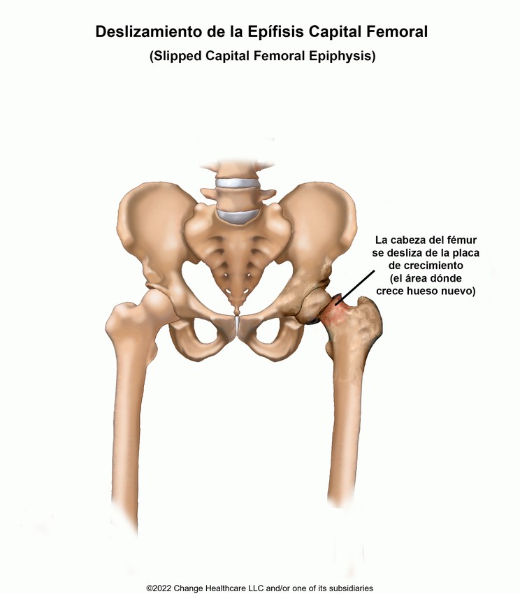 Slipped Capital Femoral Epiphysis: Illustration