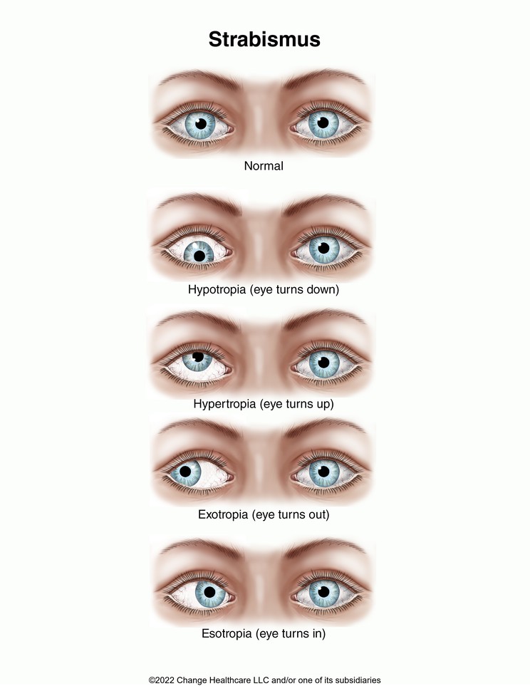 Strabismus: Illustration