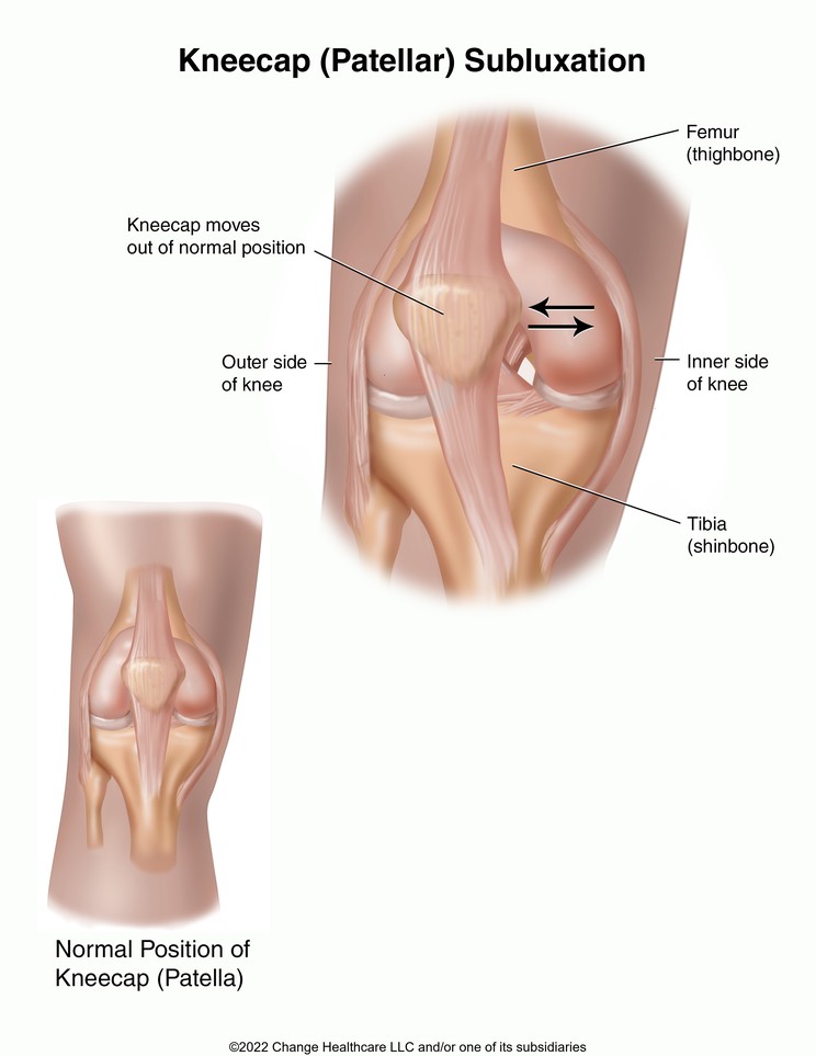 Kneecap (Patellar) Subluxation: Illustration