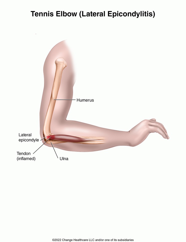 Tennis Elbow (Lateral Epicondylitis): Illustration