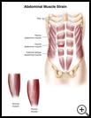 Thumbnail image of: Abdominal Muscle Strain: Illustration