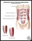 Thumbnail image of: Abdominal Muscle Strain: Illustration