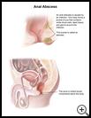 Thumbnail image of: Anal Abscess: Illustration