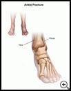 Thumbnail image of: Ankle Fracture: Illustration