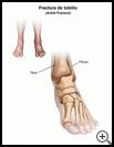 Thumbnail image of: Ankle Fracture: Illustration