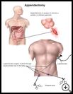 Thumbnail image of: Appendectomy: Illustration