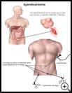 Thumbnail image of: Appendectomy: Illustration