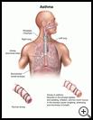 Thumbnail image of: Asthma: Illustration