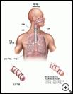 Thumbnail image of: Asthma: Illustration