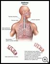 Thumbnail image of: Asthma: Illustration