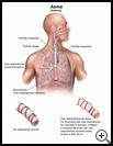 Thumbnail image of: Asthma: Illustration