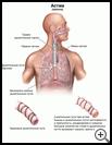 Thumbnail image of: Asthma: Illustration