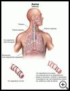 Thumbnail image of: Asthma: Illustration