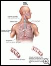 Thumbnail image of: Asthma: Illustration