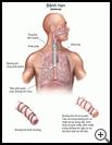 Thumbnail image of: Asthma: Illustration