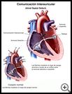 Thumbnail image of: Atrial Septal Defect: Illustration