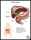 Thumbnail image of: Biliary Atresia: Illustration