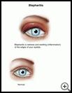 Thumbnail image of: Inflamed Eyelid (Blepharitis): Illustration