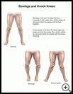 Thumbnail image of: Bowlegs and Knock Knees: Illustration