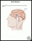 Thumbnail image of: Brain Abscess: Illustration