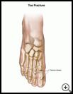 Thumbnail image of: Toe Fracture: Illustration