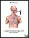 Thumbnail image of: Bronchoscopy: Illustration