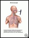 Thumbnail image of: Bronchoscopy: Illustration