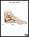 Thumbnail image of: Sever's Disease: Illustration