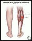 Thumbnail image of: Calf Strain: Illustration