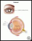 Thumbnail image of: Cataract: Illustration